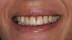Antes