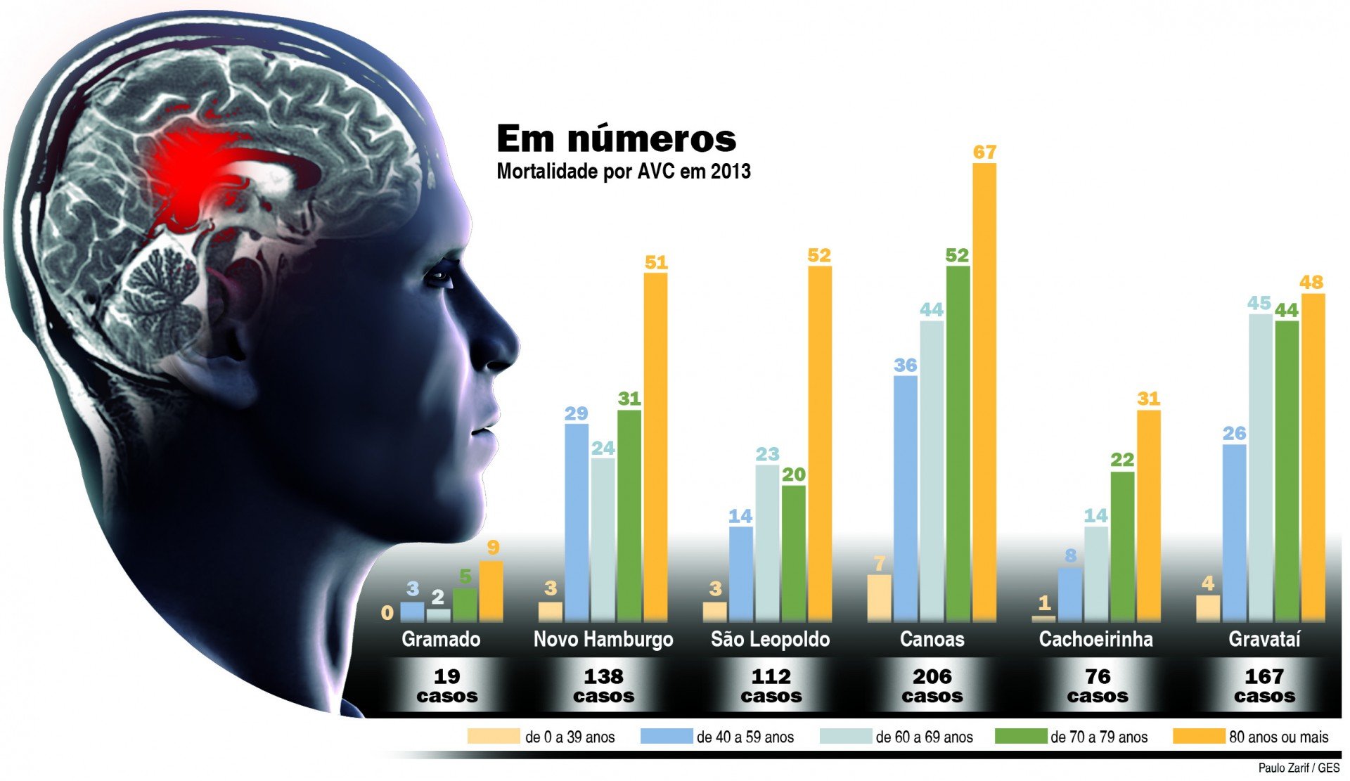 Acidente Vascular Cerebral e Outras Doenças Cerebrovasculares o