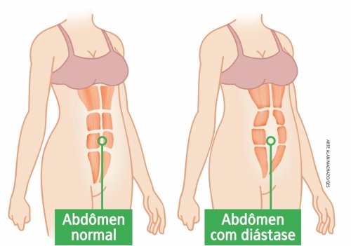 Como tratar la distension abdominal