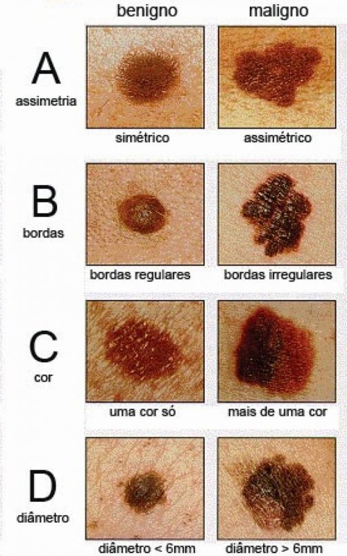Câncer de pele representa 30 dos tumores malignos no Brasil; veja como detectar Viver com Câncer de pele representa 30 dos tumores malignos no Brasil; veja como detectar Viver com
