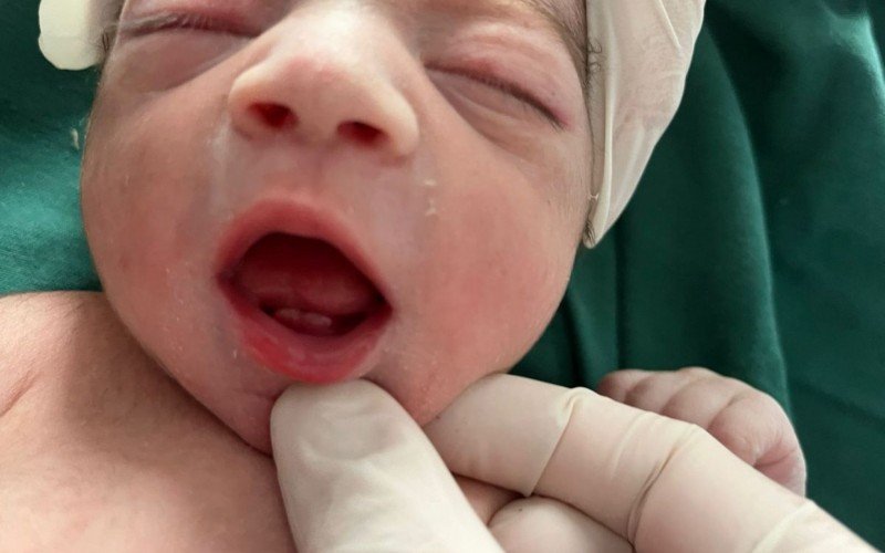 Bebê nasce com dois dentinhos e vira atração em hospital de Novo Hamburgo