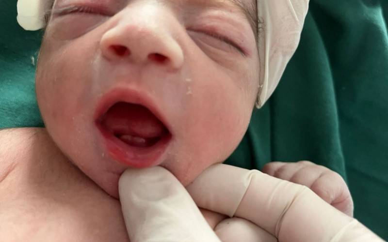 Bebê já nasceu com dois dentinhos no HMNH