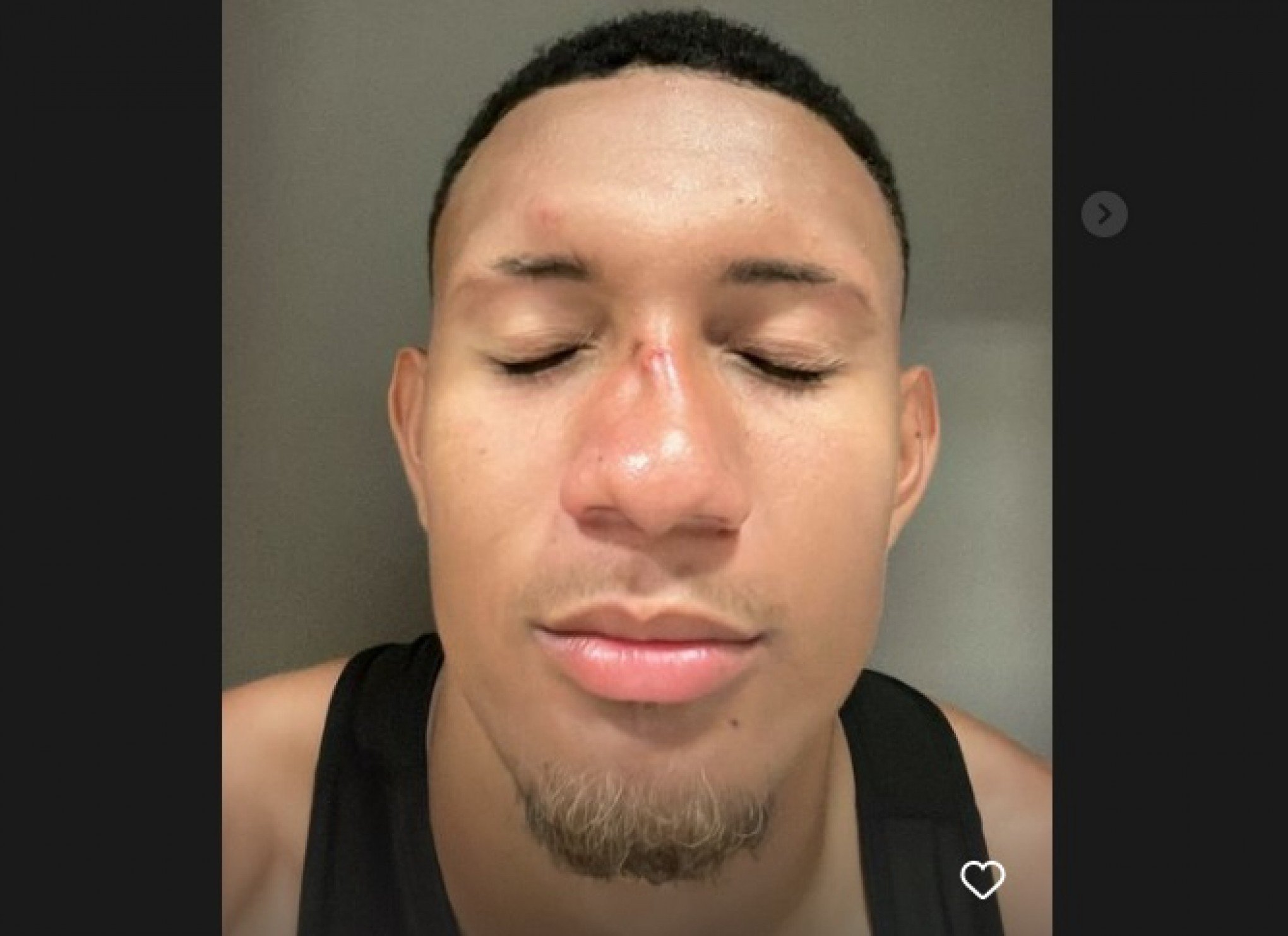 Jogador do Caxias sofre fratura no nariz após briga generalizada no  Beira-Rio, campeonato gaúcho