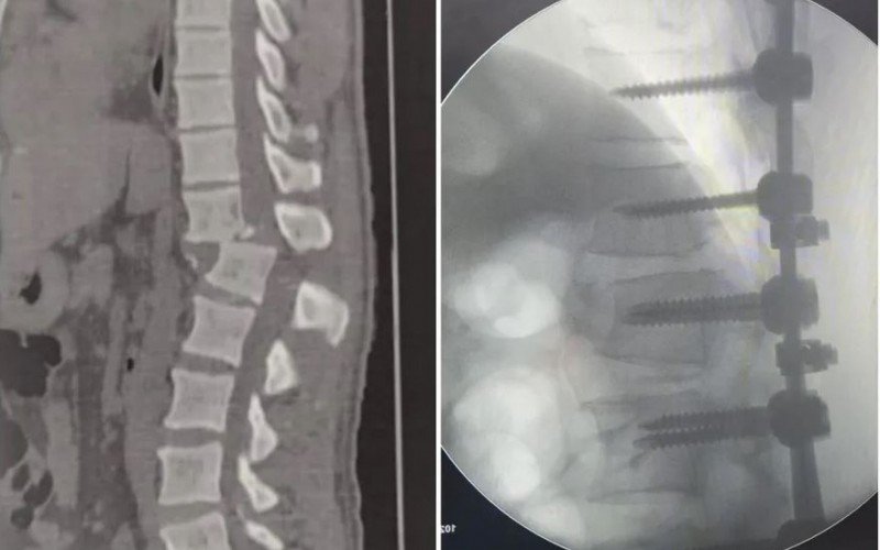 Homem atingido por aparelho em academia passa por cirurgia, veja o antes e o depois | Jornal NH