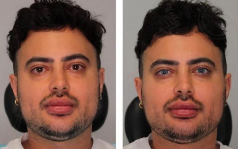 Veja o antes e depois do homem que fez um procedimento para trocar a cor dos olhos | Jornal NH