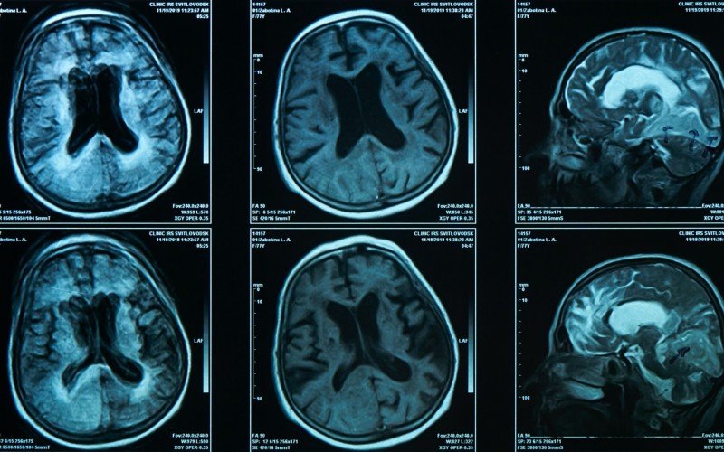 Investigação sobre origens do Alzheimer | Jornal NH