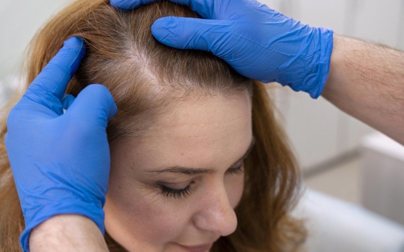 Alopecia areata é diferente da androgenética, herdada pelos pais | Jornal NH