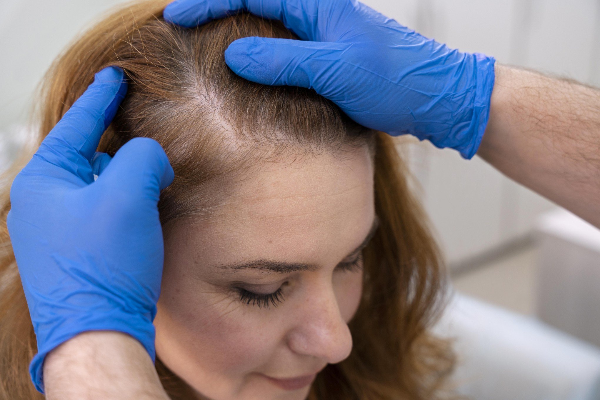 Remédio para tratamento de queda de cabelo é aprovado pela Anvisa; conheça o baricitinibe