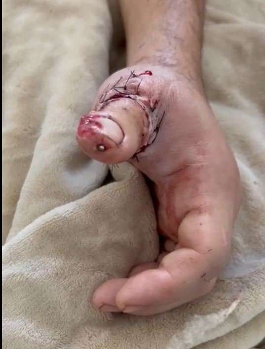 Paciente de 29 anos teve o polegar decepado durante o trabalho | abc+