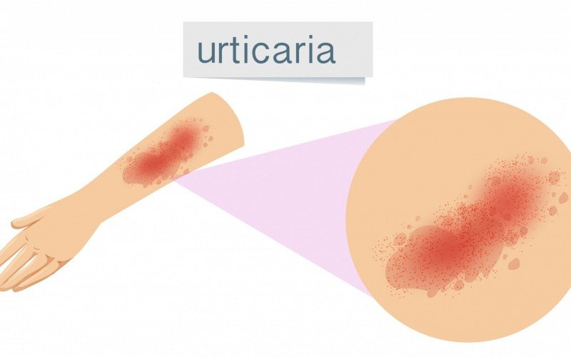 Urticária induzida é quando a pessoa entra em contato com algo que desencadeia a vermelhidão | abc+