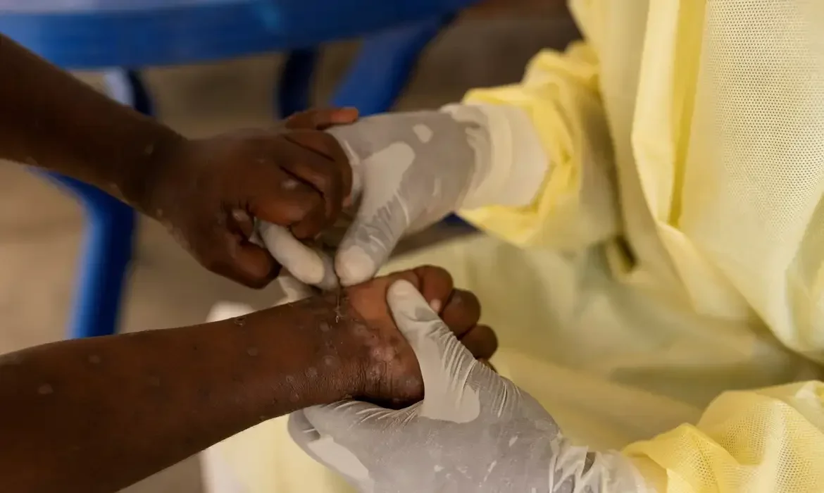 Município gaúcho registra primeiro caso de Mpox do ano