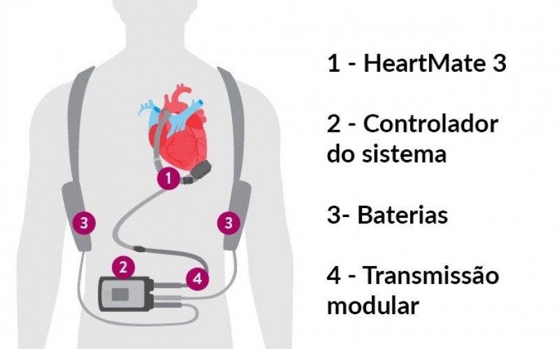 Demonstração de como funciona o dispositivo HeartMate 3