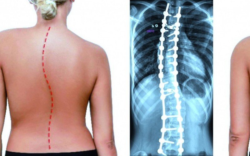 Escoliose Cirurgia | abc+