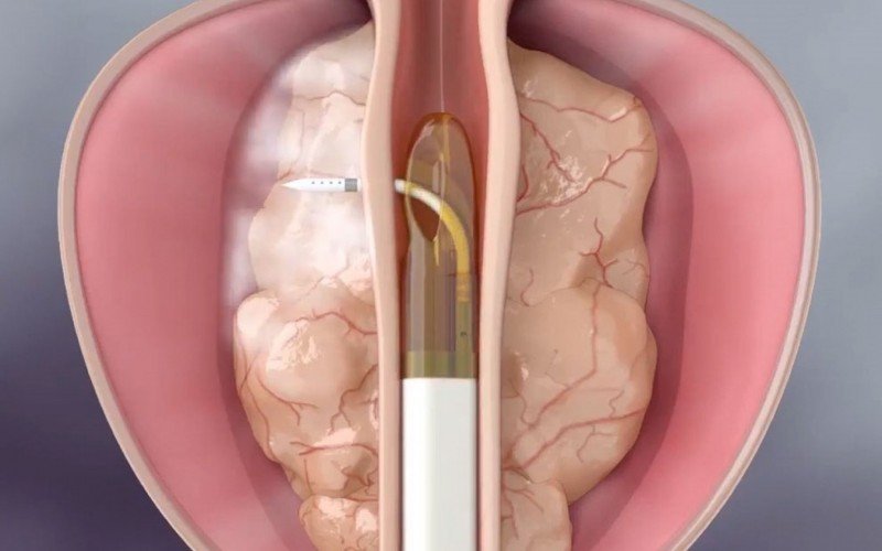 Rezum: novo procedimento trata aumento de próstata sem afetar ejaculação | abc+