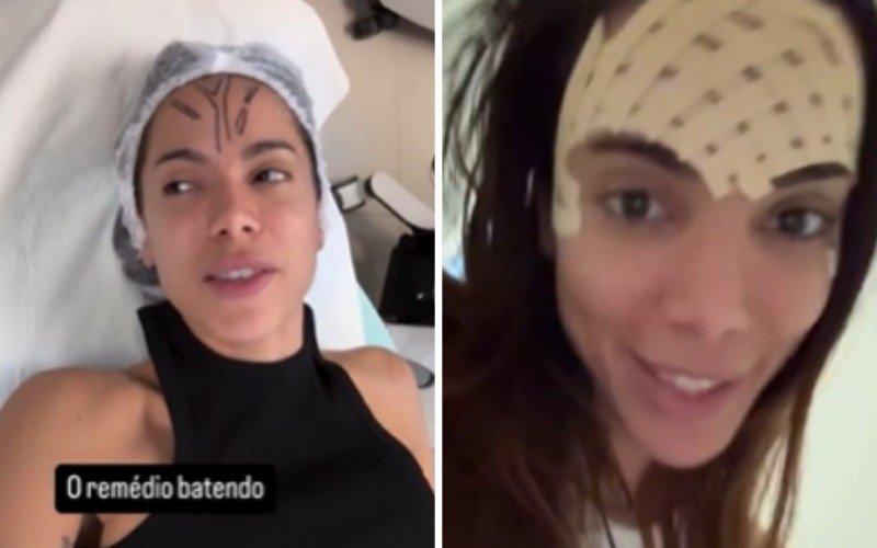 Anitta mostrou momentos antes e depois do procedimento estético na testa, no Instagram | abc+