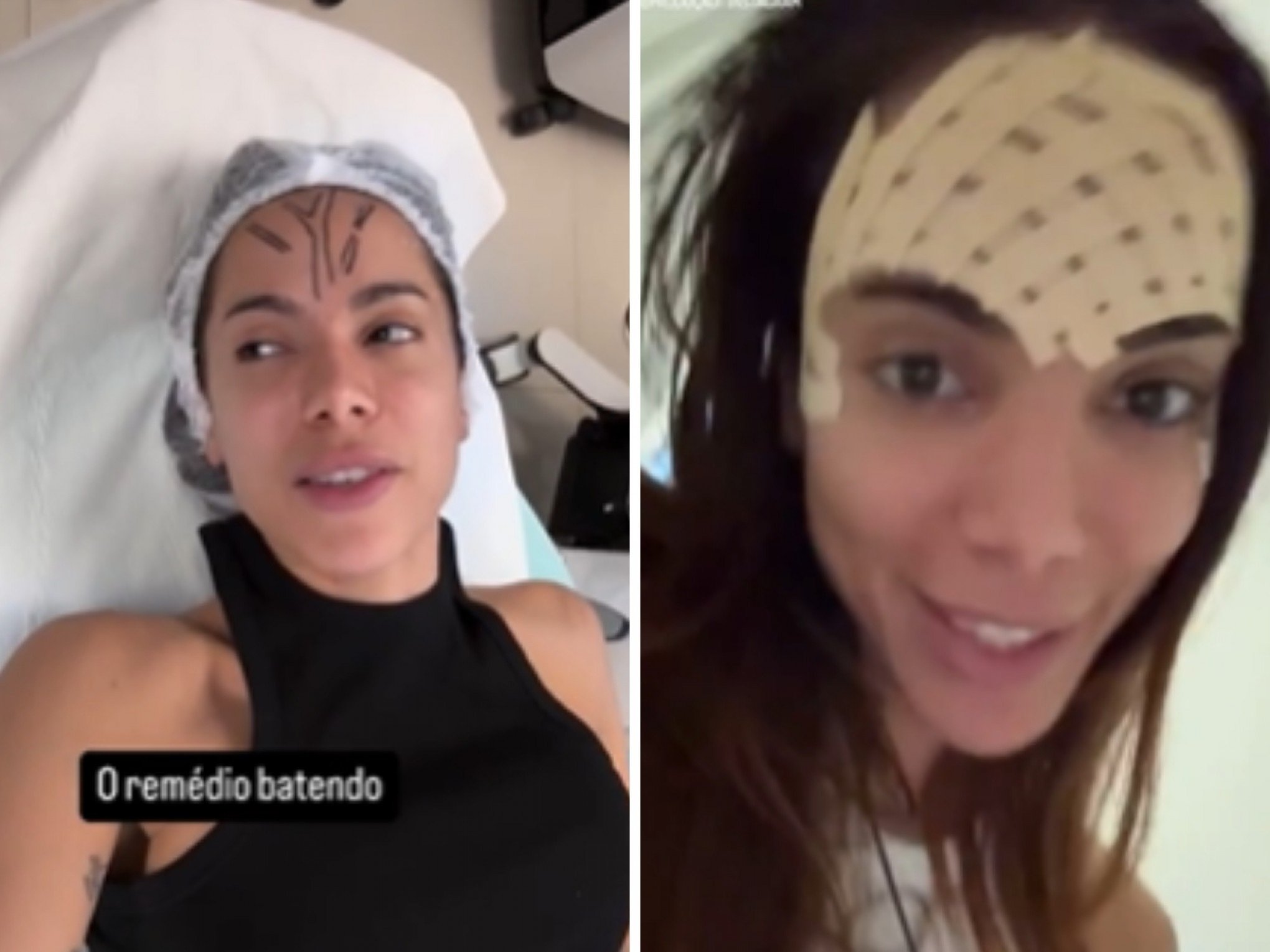 Anitta retira veia da testa e comemora resultado: "Fim de uma era!"