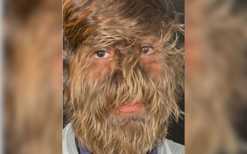 Adolescente indiano quebrou recorde com rosto mais peludo do mundo | abc+