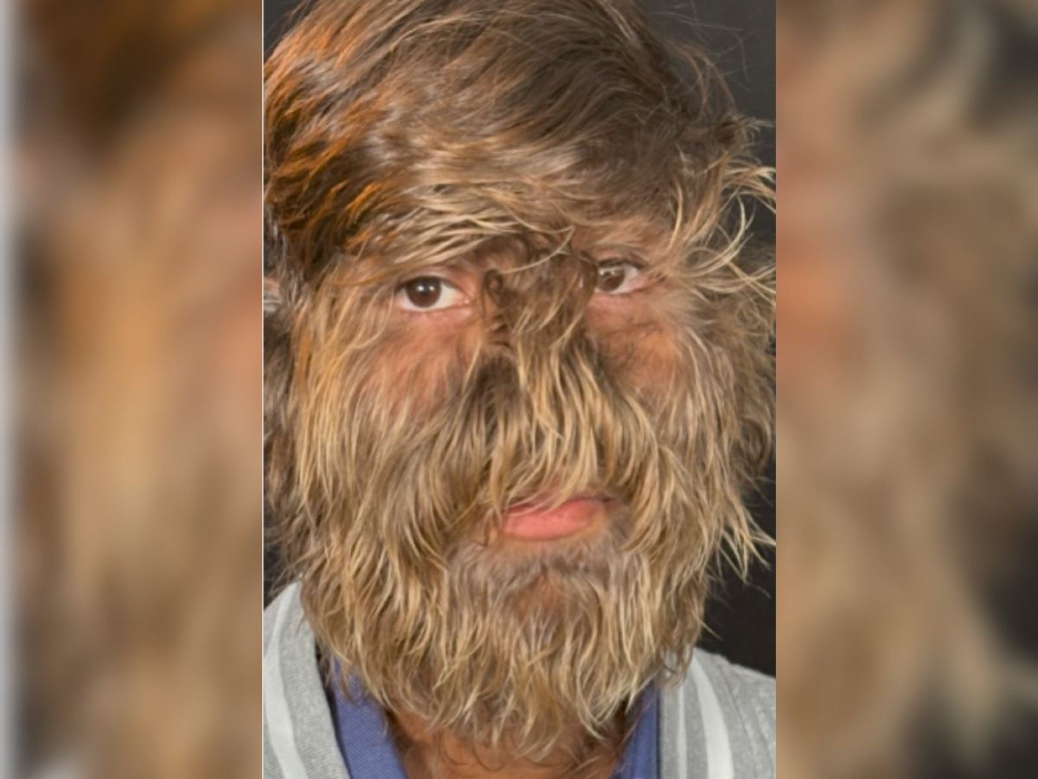 Rosto mais peludo no mundo quebra recorde e adolescente entra para o Guinness
