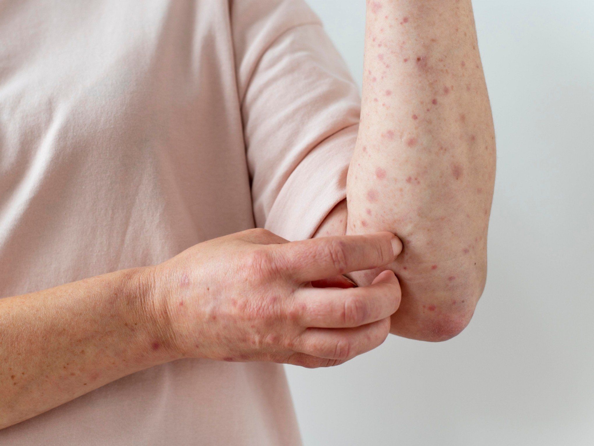 MPOX: Primeiro caso de nova cepa da doença é confirmado no Brasil