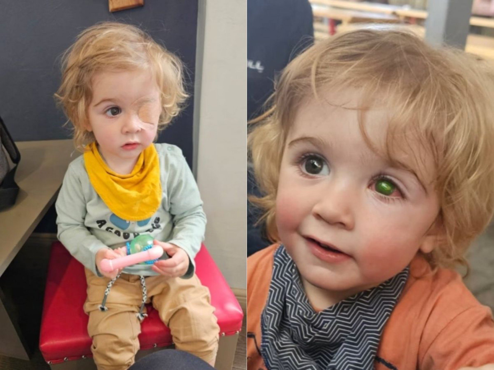 Menino de 2 anos recebe beijo de pessoa com herpes e fica cego de um olho