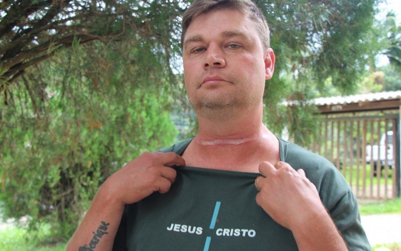 Jonatan mostra a queimadura do fio em seu pescoço | abc+