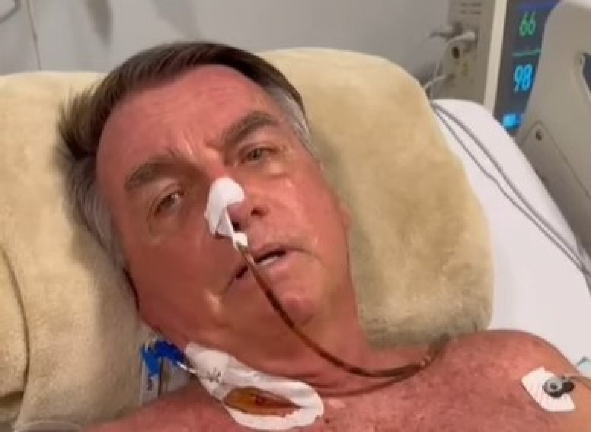 Bolsonaro vai passar por cirurgia no intestino neste domingo em Brasília