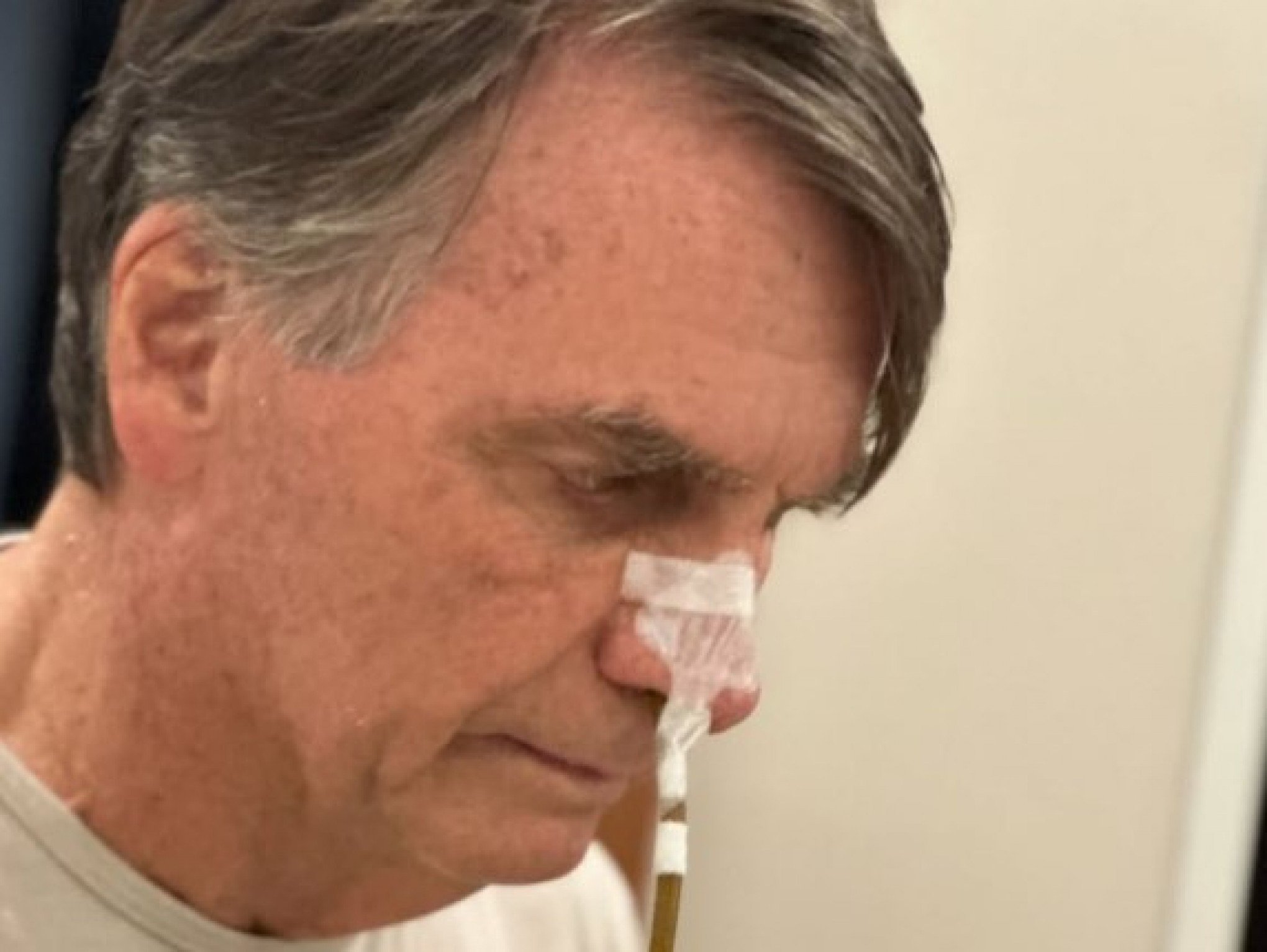 Bolsonaro apresenta piora; veja quadro de saúde do ex-presidente