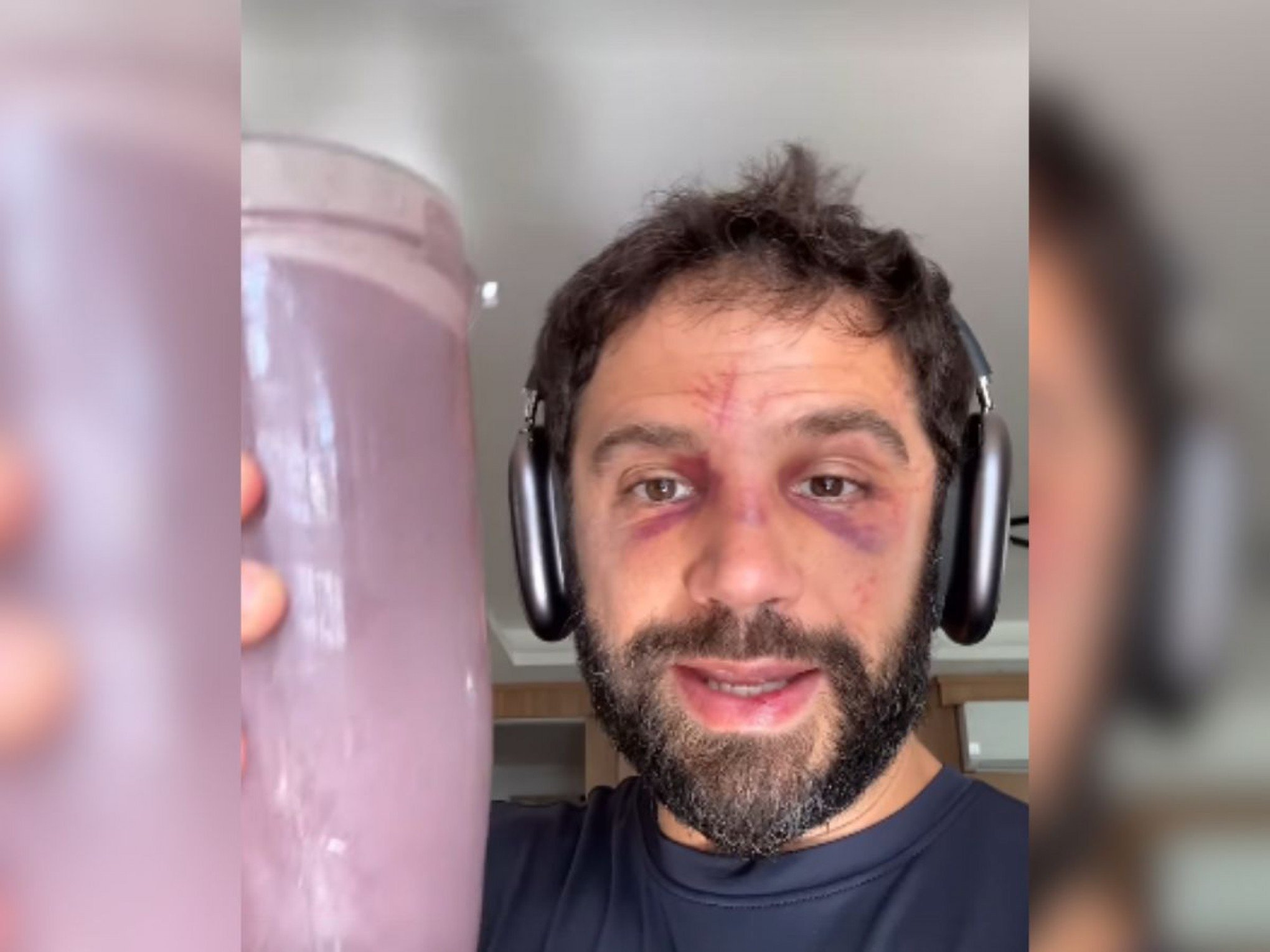 Duda Nagle faz balanço de luta com Popó e revela que quebrou "apenas o nariz"