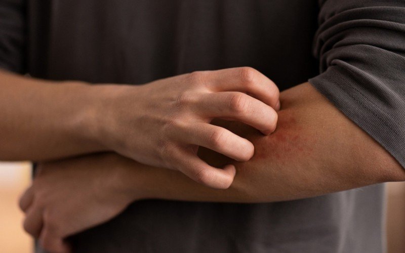 Quem sofre com dermatite atópica já pode fazer o tratamento integral pelo SUS | abc+