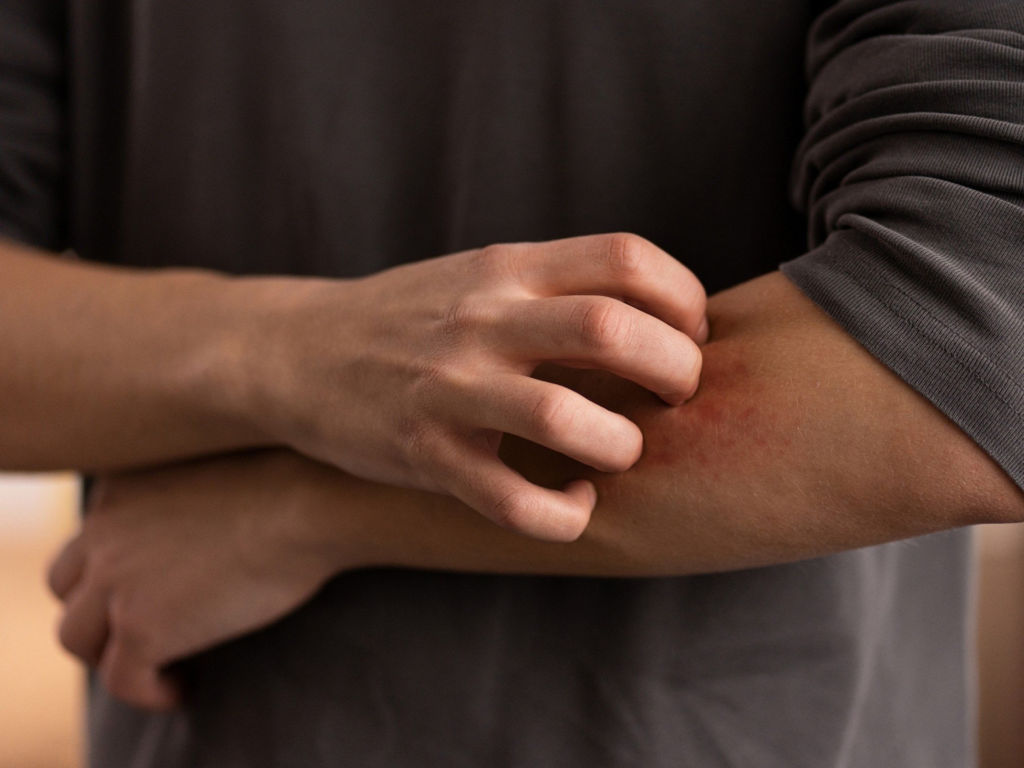 Dermatite atópica: Novos remédios chegam ao SUS para tratar doença de pele; saiba quais e principais sintomas