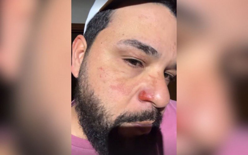 Cantor Léo mostrou cicatrizes após sofrer queimaduras durante show | abc+
