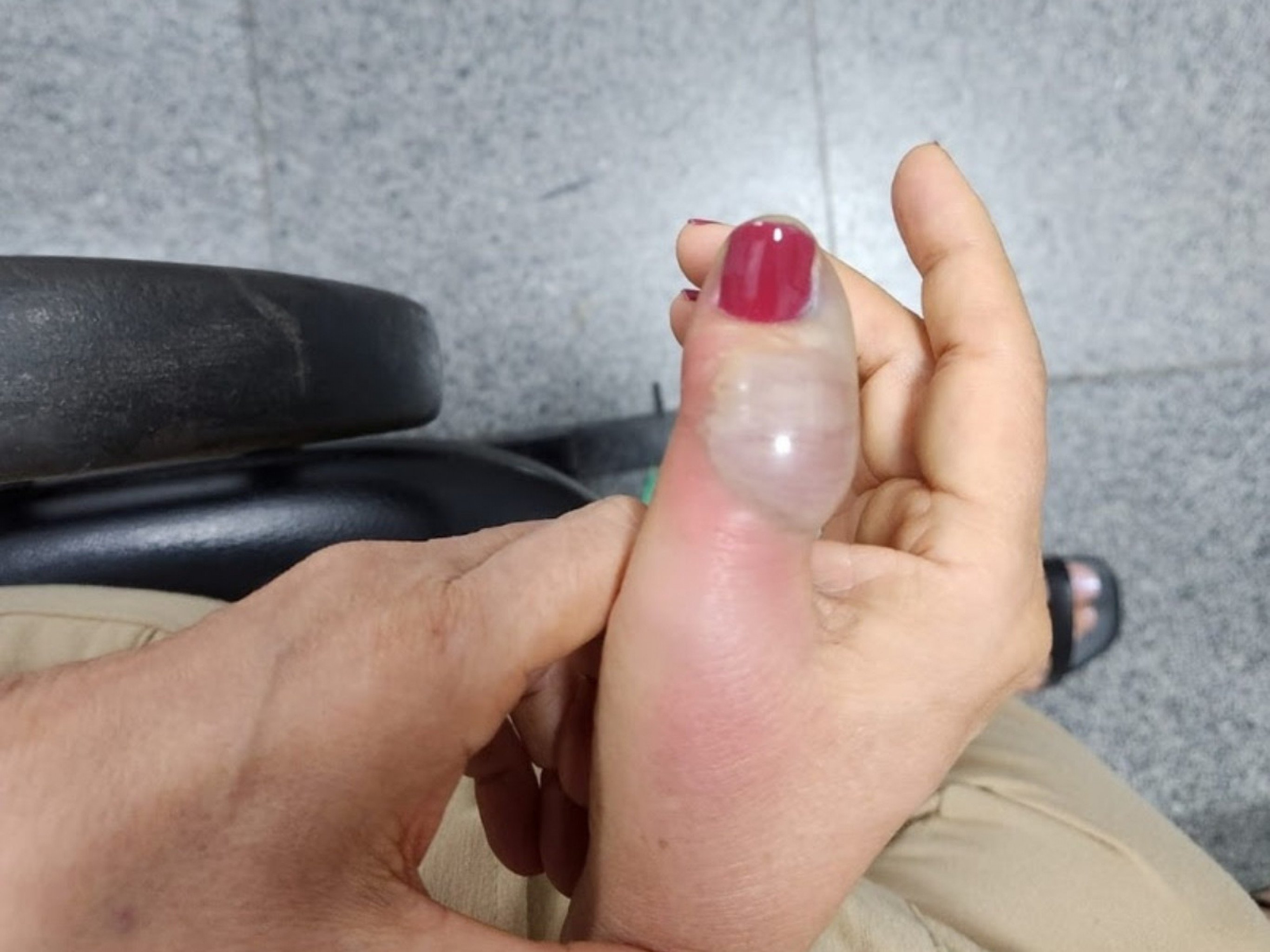 Dedo de mulher necrosa após fazer unhas no salão: 4 cirurgias foram necessárias para salvar o membro; entenda os perigos