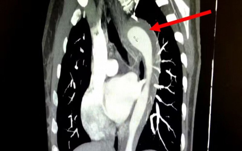 Hematoma intramural da aorta torácica em tomografia de tórax | abc+