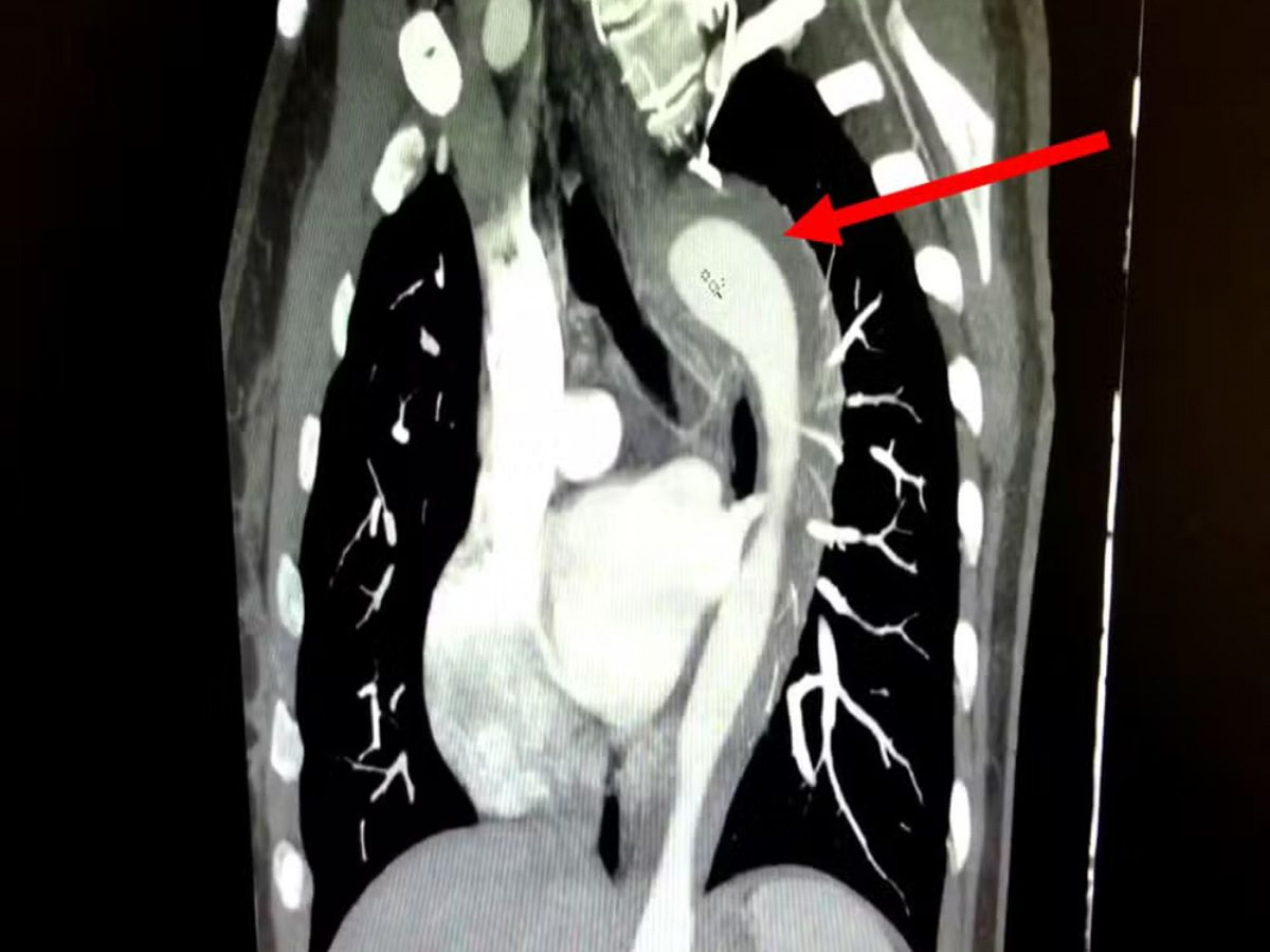 Mulher rompe aorta ao atingir o orgasmo e passa por cirurgia de emergência