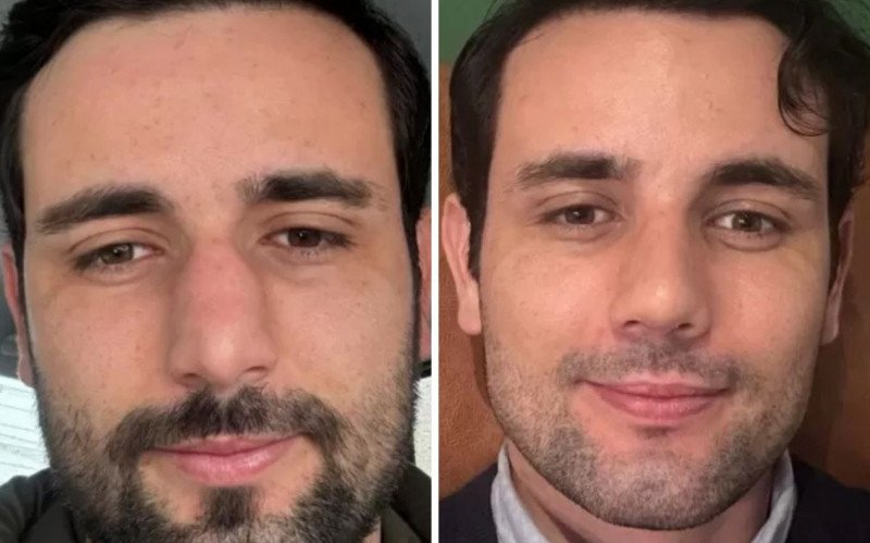 Matteus Amaral mostrou resultado de rinoplastia nas redes sociais | abc+