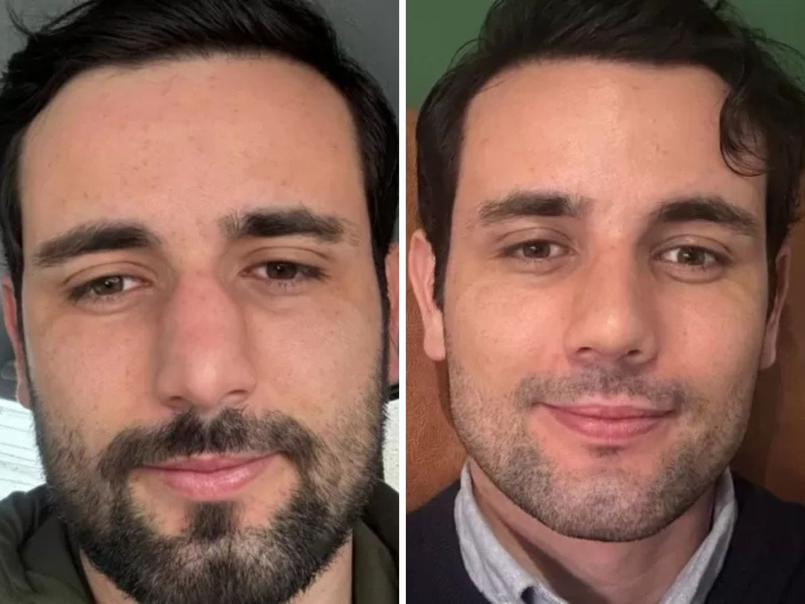 Ex-BBB Matteus exibe resultado de cirurgia plástica: "Me sentindo um pouco estranho"