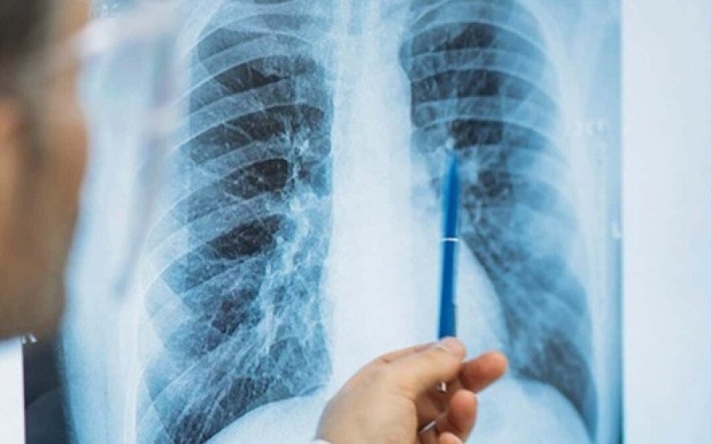 Tuberculose números de casos crescentes na região  | abc+