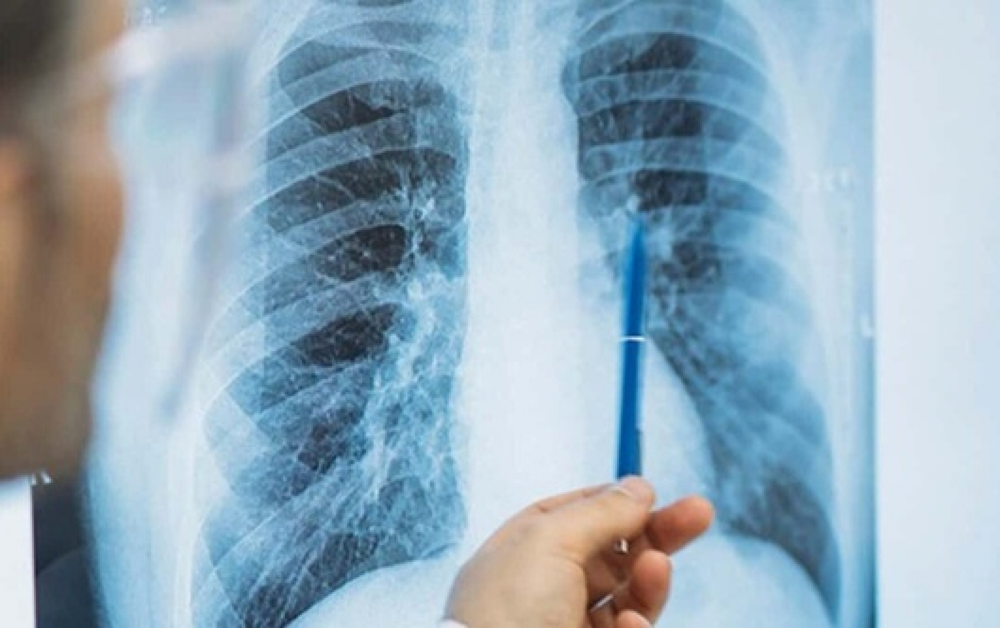 Tuberculose mata mais de 1,2 milhão de pessoas por ano, aponta OMS