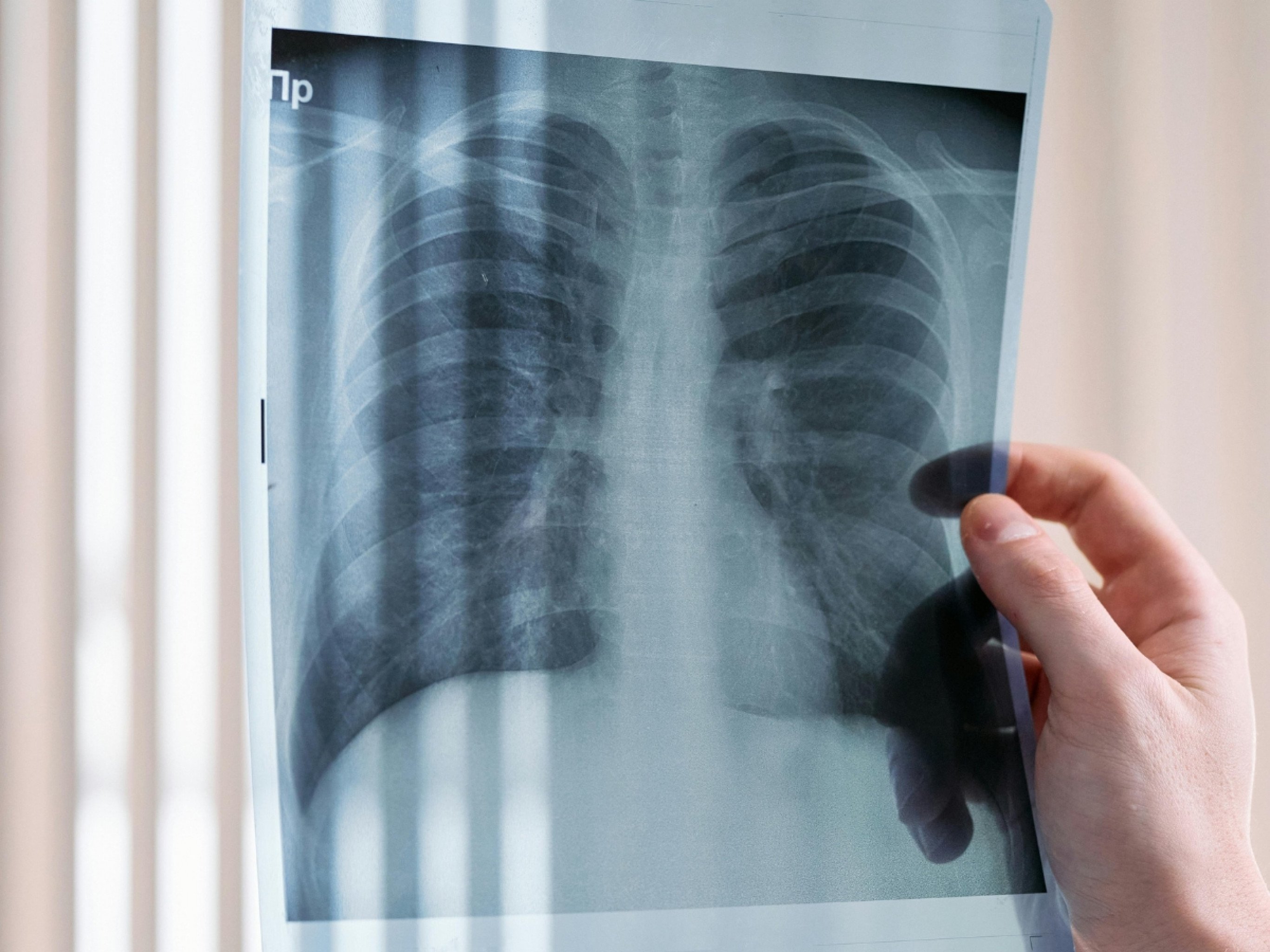 Tuberculose é principal causa de morte no mundo por doença infecciosa, alerta OMS; conheça os principais sintomas