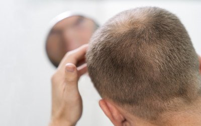 Café causa calvície? Veja o que diz a Anvisa