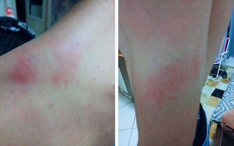 Motociclista tirou fotos que mostram os hematomas pelo corpo após a abordagem realizada por guardas municipais | abc+