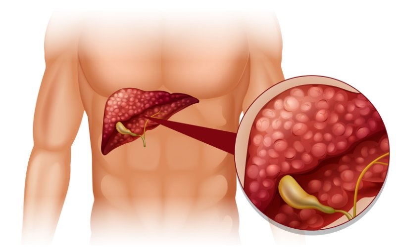 Elimine a gordura no fígado: 5 hábitos recomendados pelos médicos para evitar e controlar a esteatose hepática