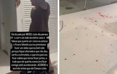 Miss Gramado compartilha imagens com sangue após briga com Dado Dolabella
