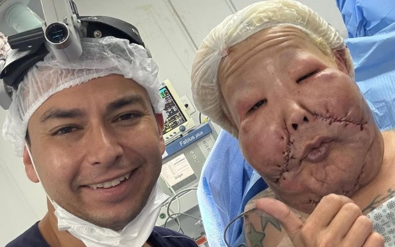 Juju do Pix após cirurgias para retirada do óleo mineral injetado clandestinamente no rosto