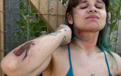 Fio solto na via enrosca no pescoço de jovem e provoca queda de moto no litoral norte