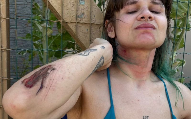 Isabela Bossle Hoffmann ficou ferida após colidar contra fio solto em Tramandaí | abc+