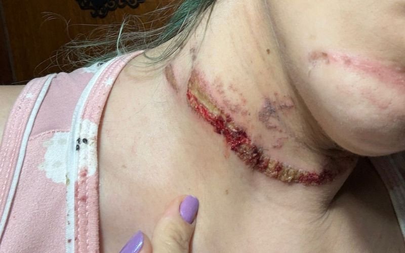 Isabela Bossle Hoffmann ficou ferida após colidar contra fio solto em Tramandaí