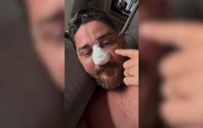 Turista agredido em Porto de Galinhas passa por cirurgia para corrigir quatro fraturas no rosto