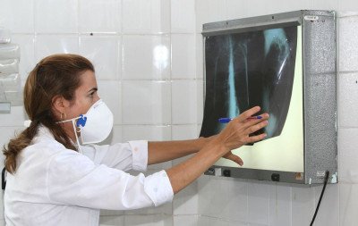 Testes de diagnóstico rápido para erradicar tuberculose são recomendados pela OMS