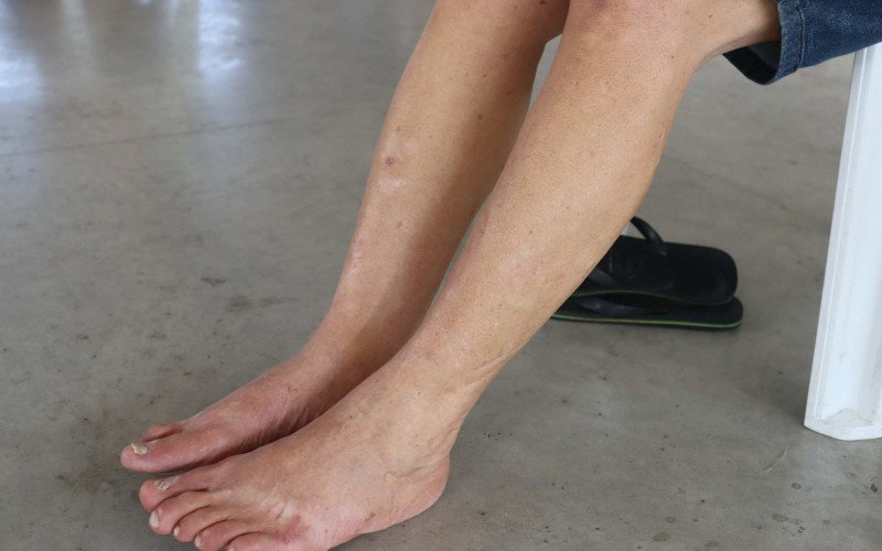 Quem tem diabetes precisa redobrar os cuidado com os pés | abc+